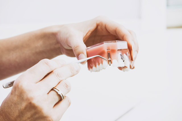 Ansicht für Zahnimplantate in der Zahnarztpraxis
